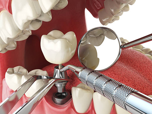 Best Urgent Care for Lost Fillings or Crowns in Meridian Hills, IN